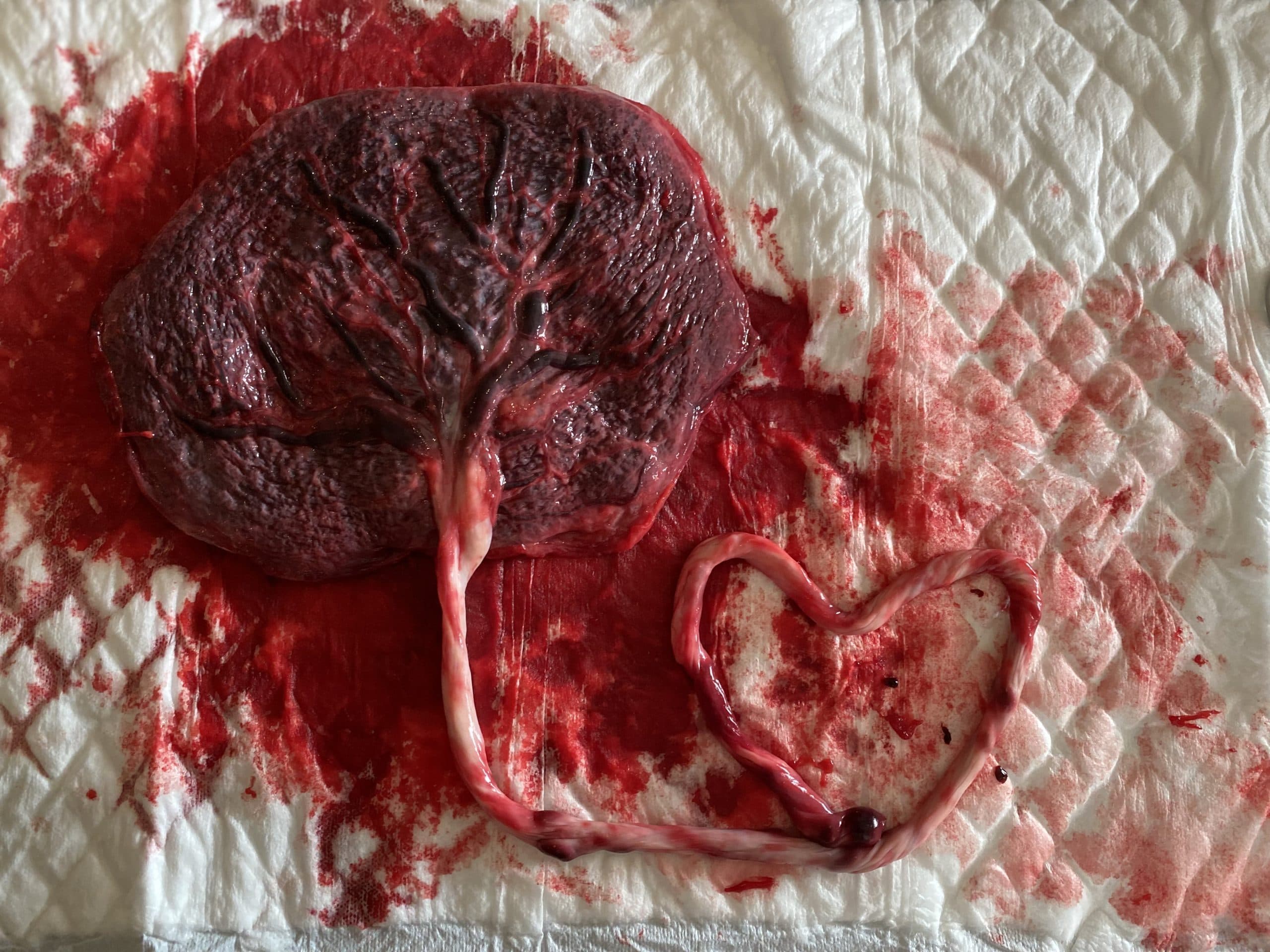 The Placenta and the umbilical cord.