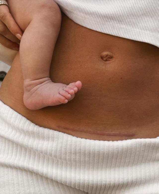 10 Risks of C-Sections for Mother and Baby